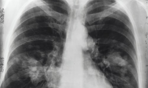 respiratory illness facts