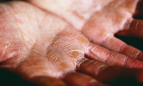 revitol eczema facts